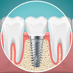 Titanium Electrodes Help Fight Dental Infections