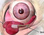 Wireless Implant Treats Dry Eye